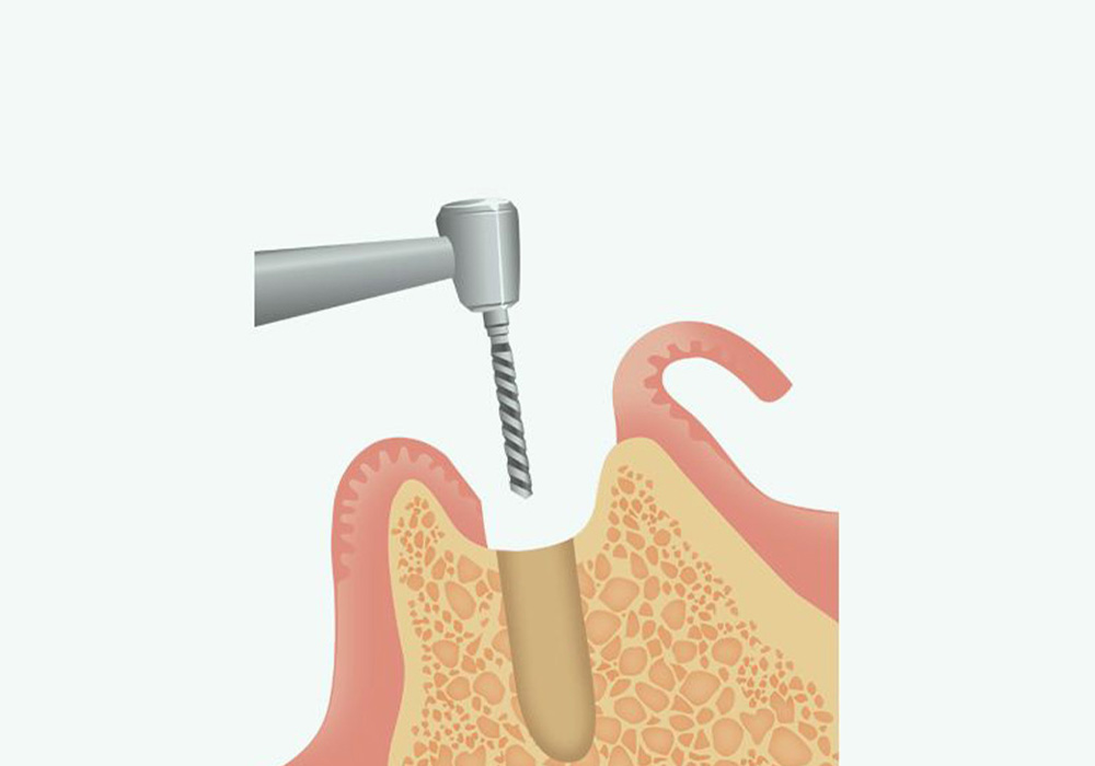 インプラント体の埋入