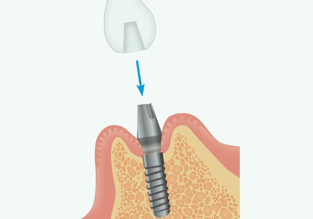 人工歯の型取り、仮歯の装着