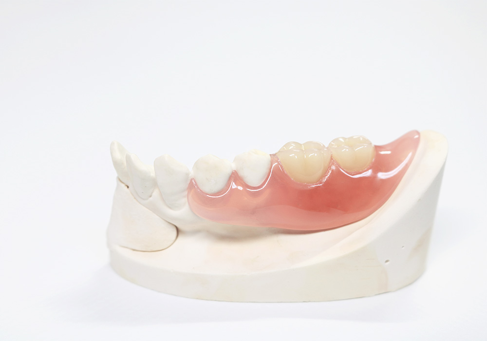 ノンクラスプデンチャー（自由診療の部分入れ歯）