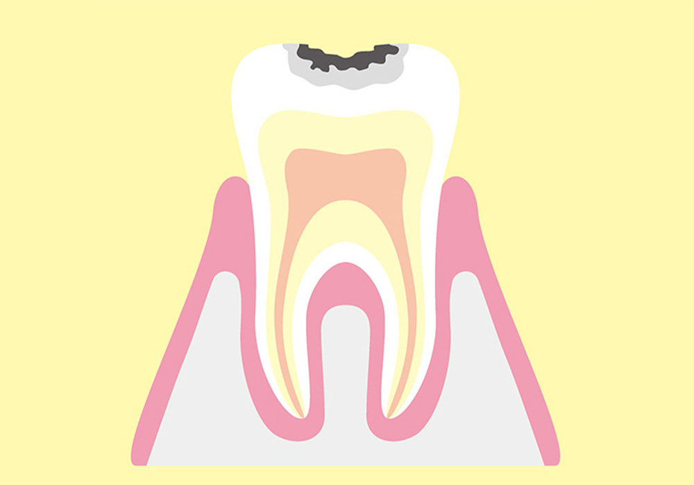 エナメル質のみのむし歯(C1)