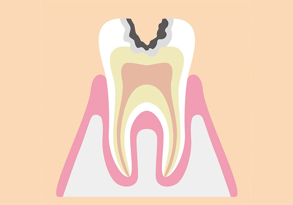 象牙質まで進行したむし歯(C2)