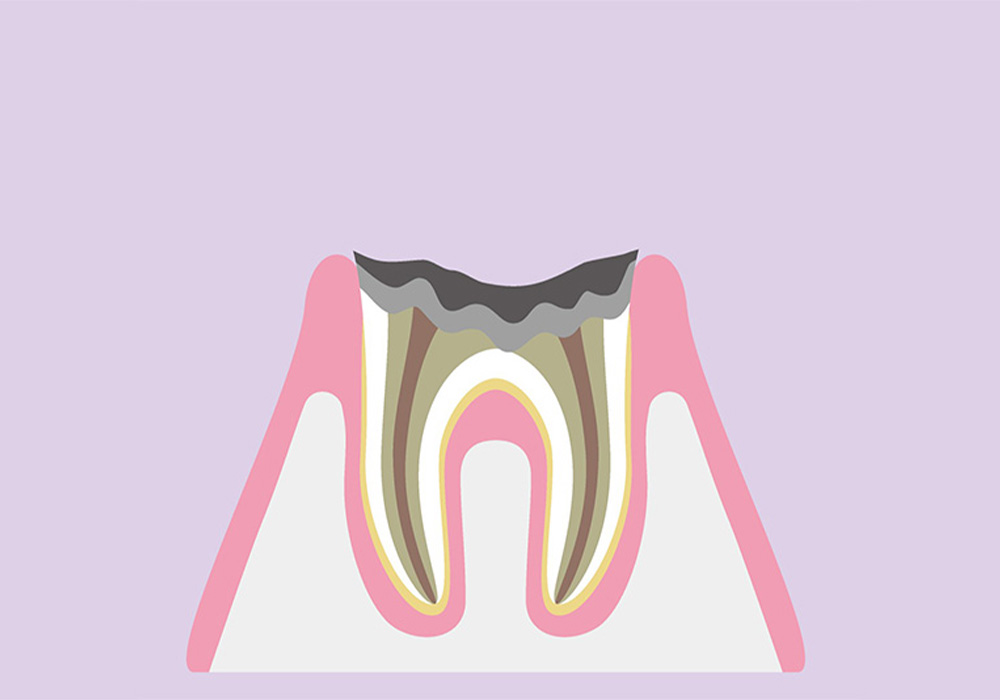 歯根だけ残ったむし歯(C4)