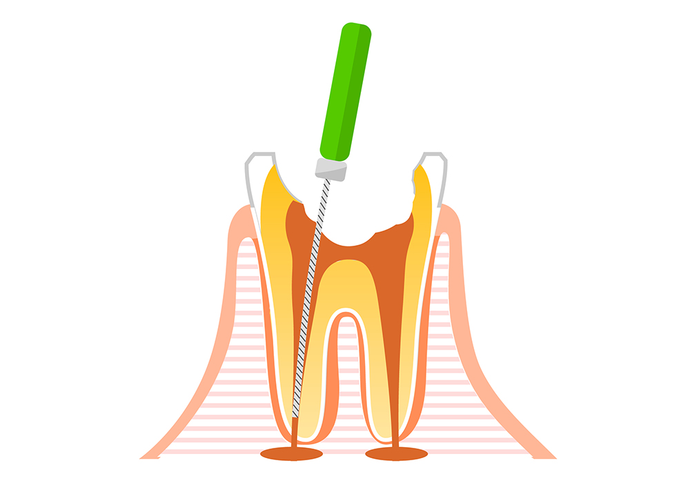 根管治療