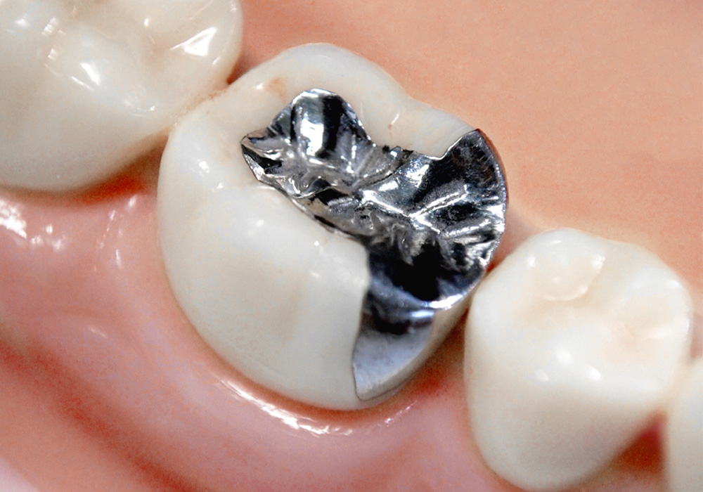 銀色の詰め物・被せ物
