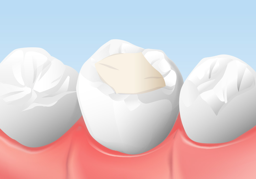 レジンの詰め物（レジン充填）
