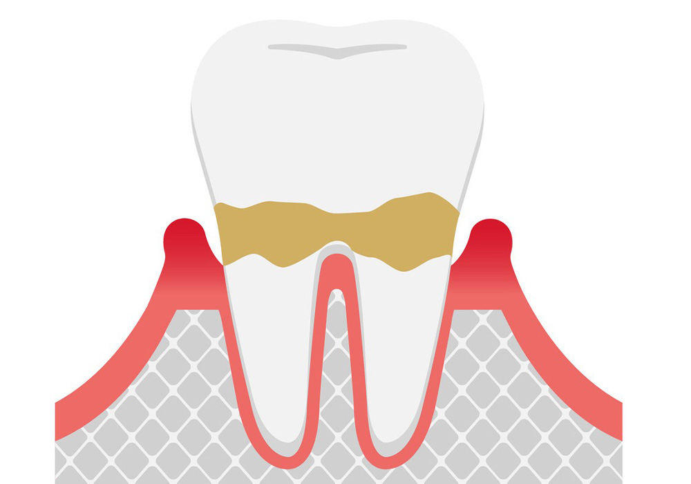 歯周炎（軽度）
