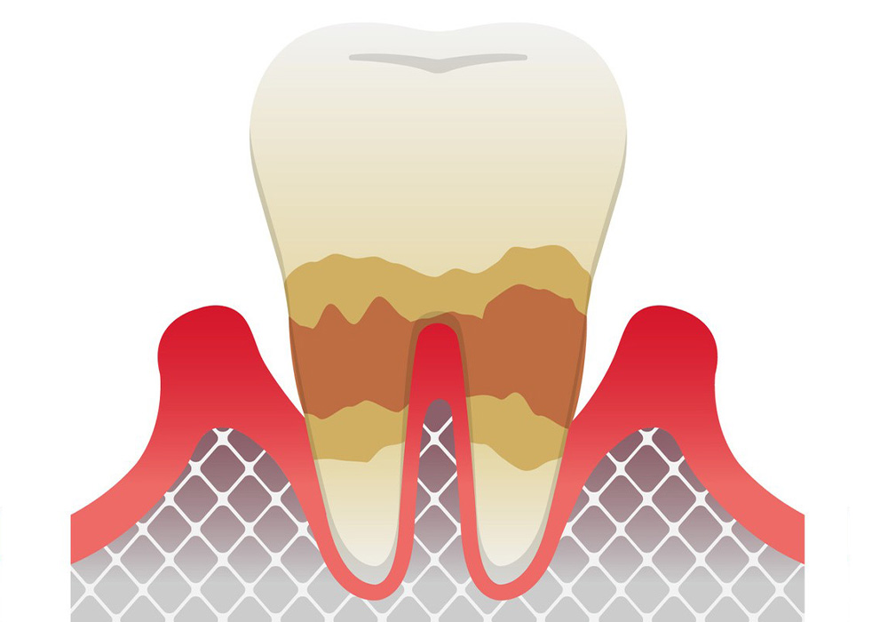 歯周炎（中度）