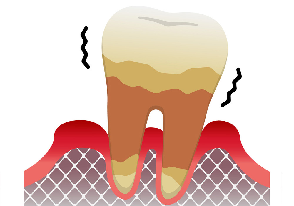 歯周炎（重度）